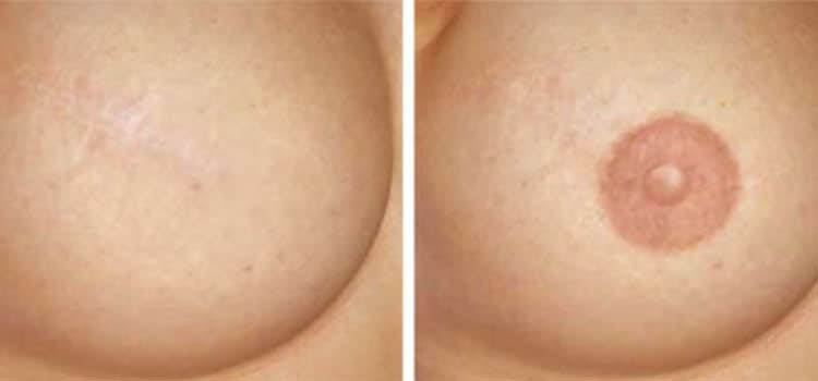 Areola-Restoration in Mission Viejo