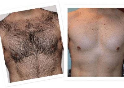 electrolysis-for-men-orange-county