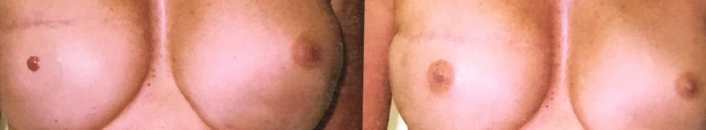 Areola Restoration following Breast Reconstruction surgery