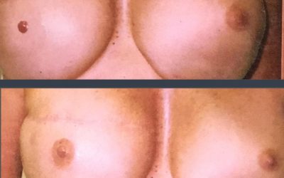 Areola Restoration following Breast Reconstruction surgery