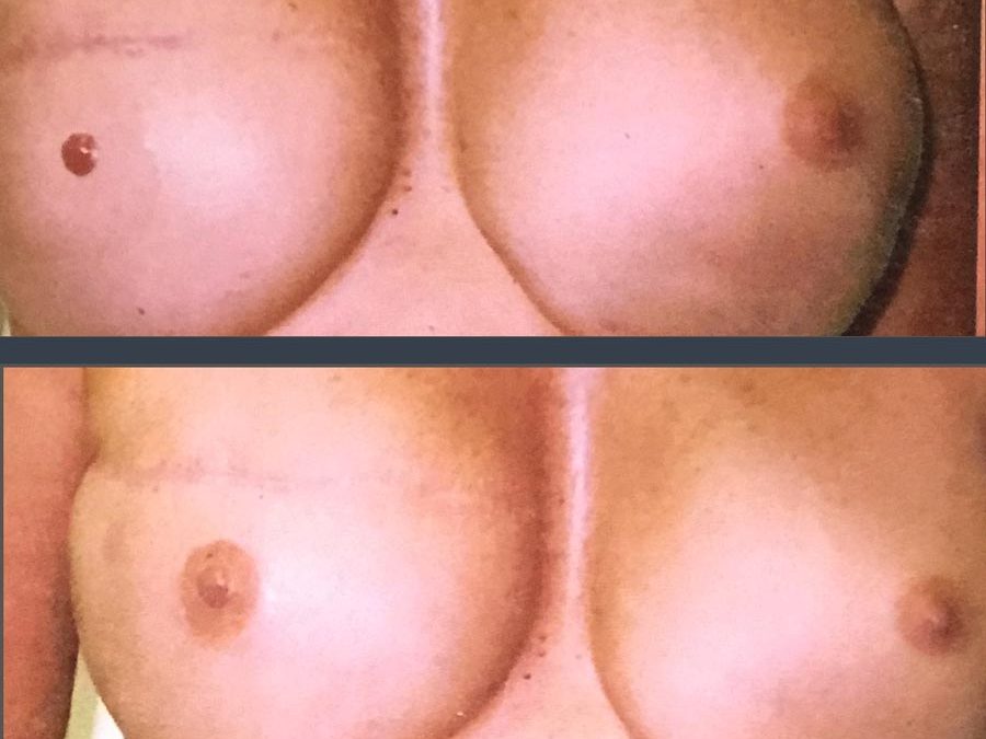 Areola Restoration following Breast Reconstruction surgery